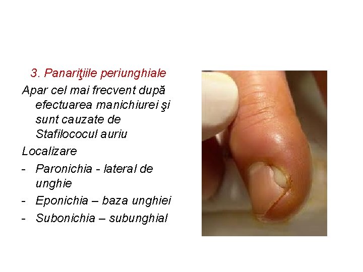 3. Panariţiile periunghiale Apar cel mai frecvent după efectuarea manichiurei şi sunt cauzate de