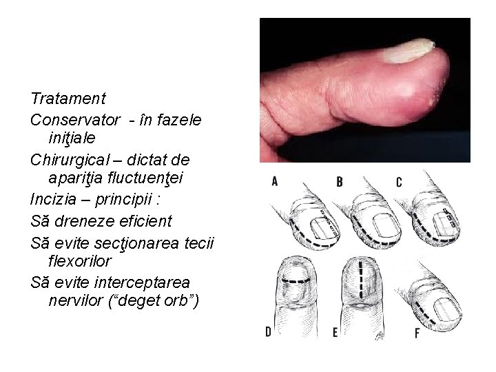 Tratament Conservator - în fazele iniţiale Chirurgical – dictat de apariţia fluctuenţei Incizia –