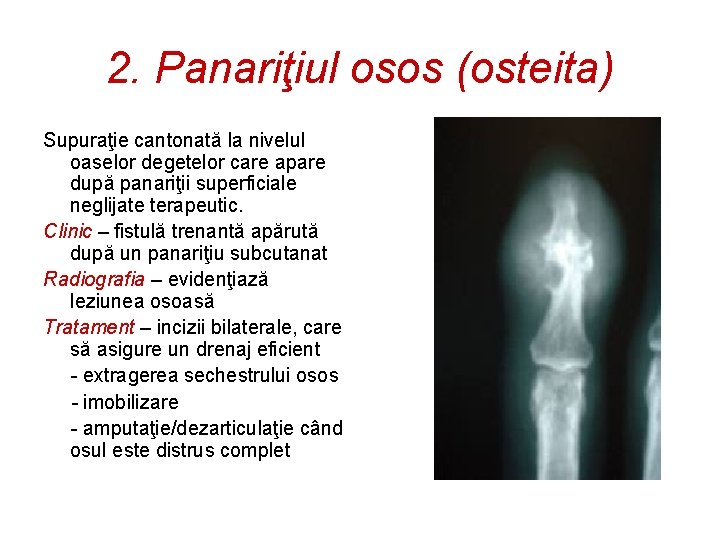 2. Panariţiul osos (osteita) Supuraţie cantonată la nivelul oaselor degetelor care apare după panariţii