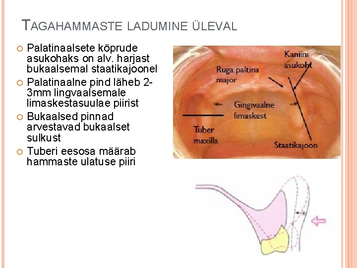 TAGAHAMMASTE LADUMINE ÜLEVAL Palatinaalsete köprude asukohaks on alv. harjast bukaalsemal staatikajoonel Palatinaalne pind läheb TAGAHAMMASTE LADUMINE ÜLEVAL Palatinaalsete köprude asukohaks on alv. harjast bukaalsemal staatikajoonel Palatinaalne pind läheb