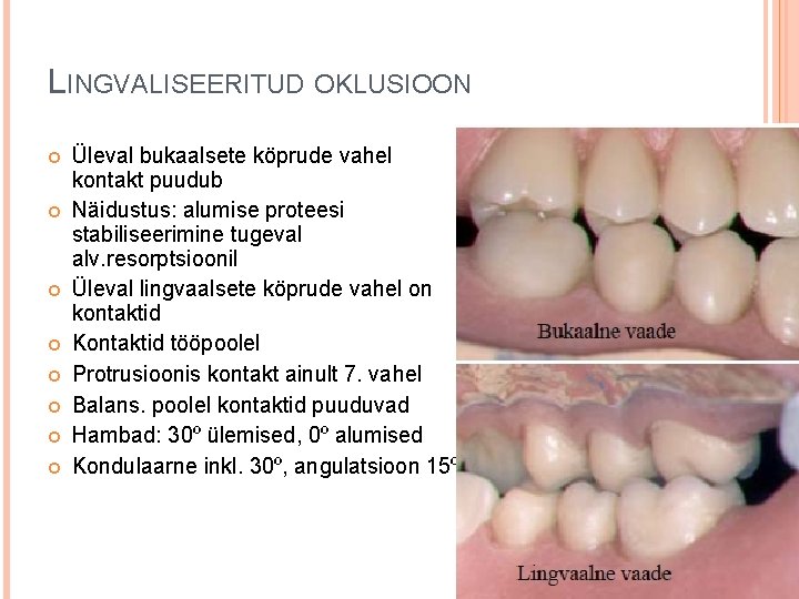 LINGVALISEERITUD OKLUSIOON Üleval bukaalsete köprude vahel kontakt puudub Näidustus: alumise proteesi stabiliseerimine tugeval alv.