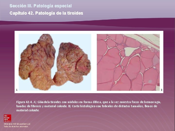 Sección III. Patología especial Capítulo 42. Patología de la tiroides Figura 42 -4. A)