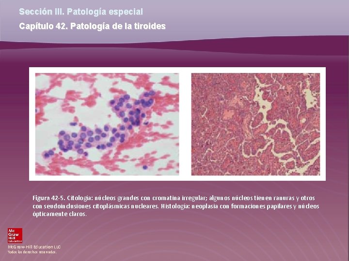 Sección III. Patología especial Capítulo 42. Patología de la tiroides Figura 42 -5. Citología: