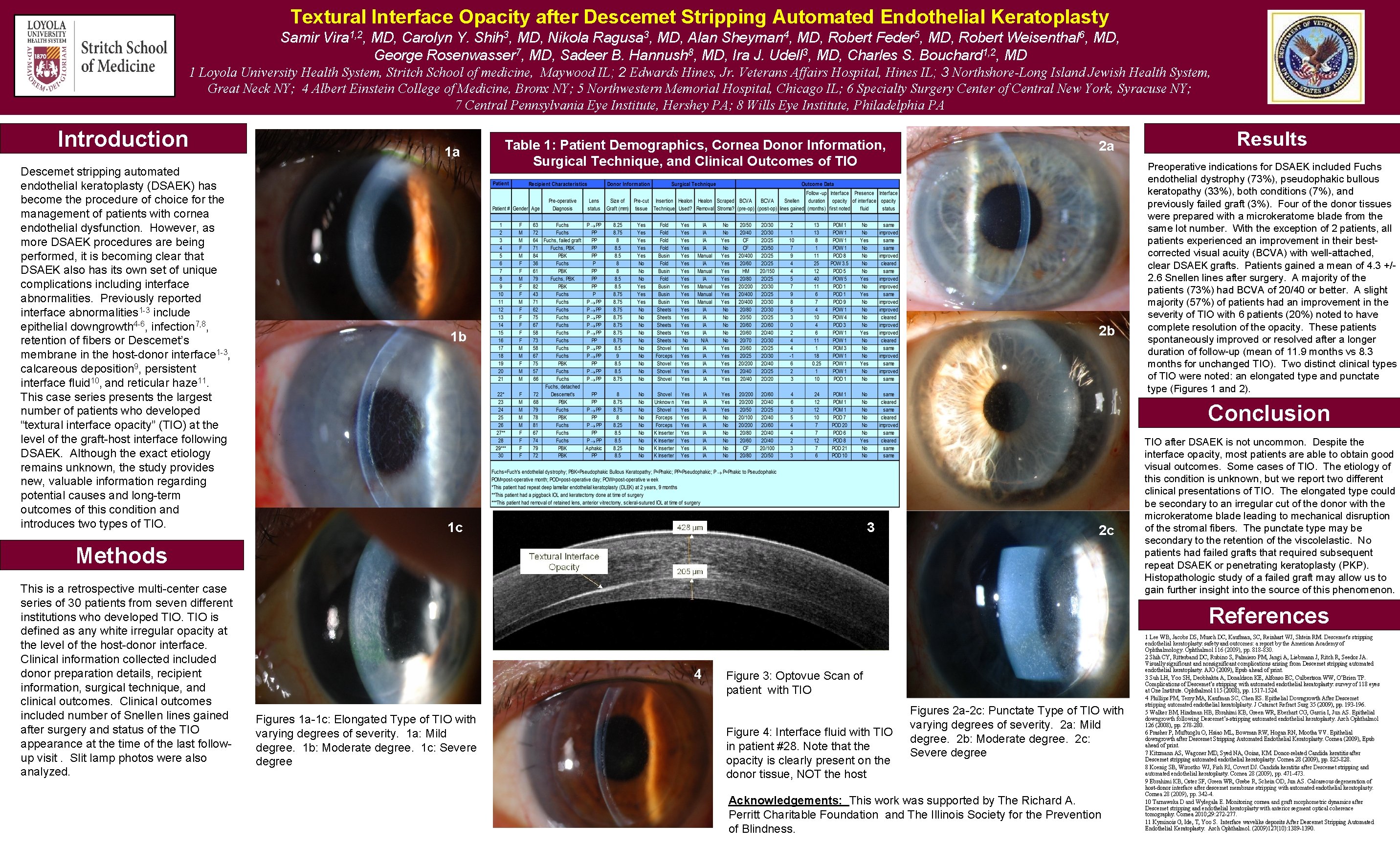 Textural Interface Opacity after Descemet Stripping Automated Endothelial Keratoplasty Samir Vira 1, 2, MD,