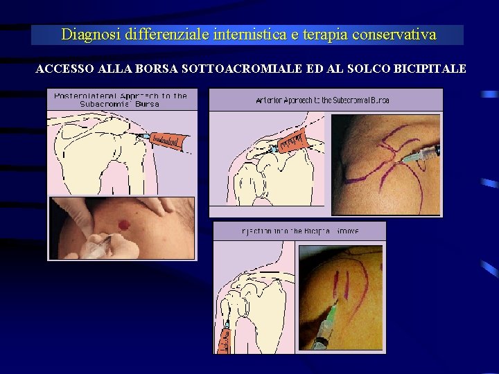 Diagnosi differenziale internistica e terapia conservativa ACCESSO ALLA BORSA SOTTOACROMIALE ED AL SOLCO BICIPITALE