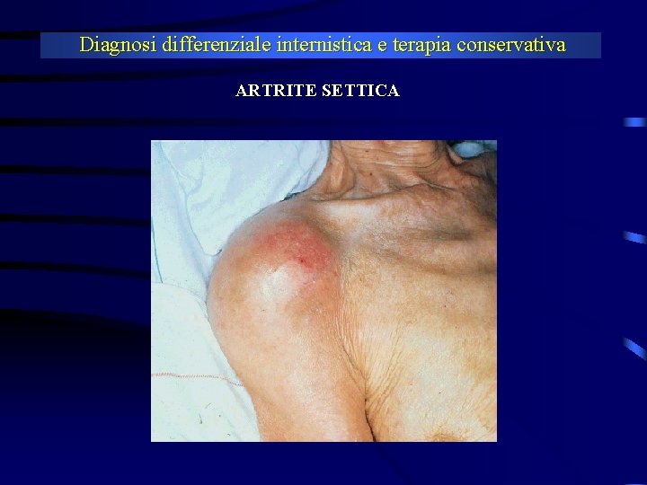 Diagnosi differenziale internistica e terapia conservativa ARTRITE SETTICA 