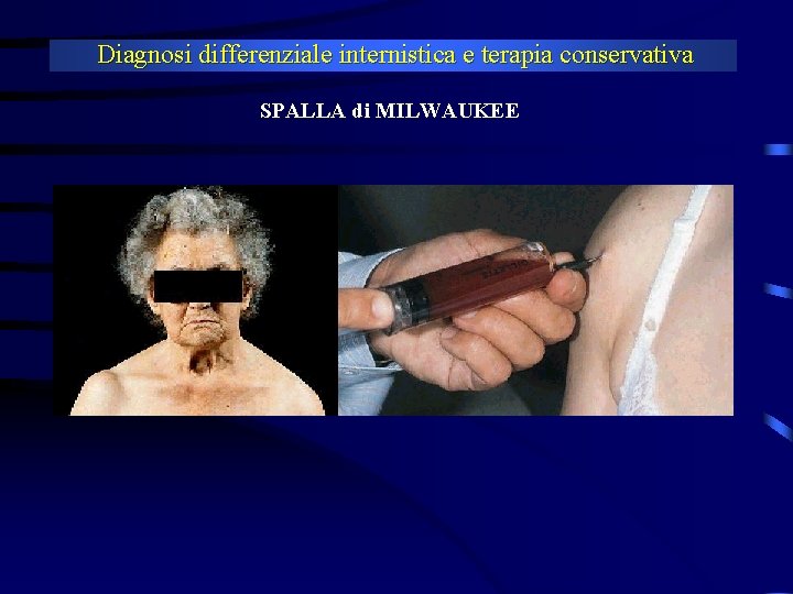 Diagnosi differenziale internistica e terapia conservativa SPALLA di MILWAUKEE 