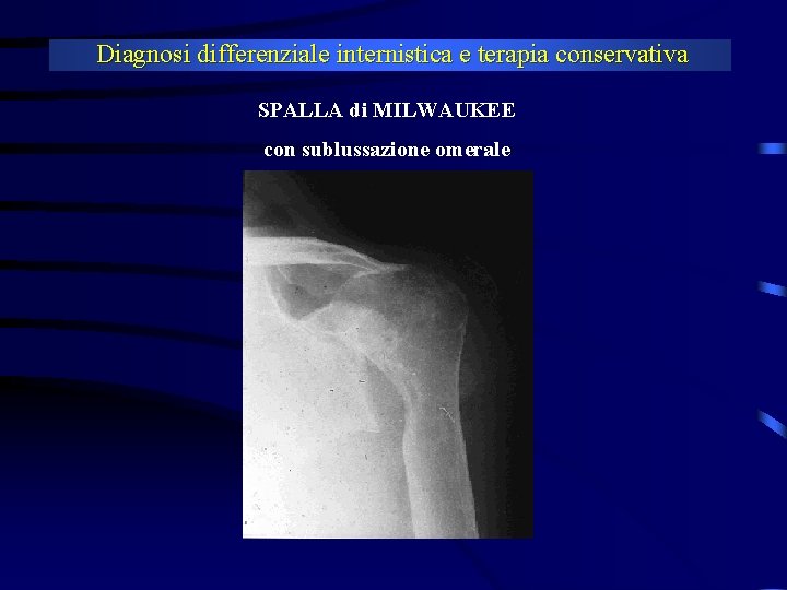 Diagnosi differenziale internistica e terapia conservativa SPALLA di MILWAUKEE con sublussazione omerale 