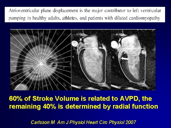 60% of Stroke Volume is related to AVPD, the remaining 40% is determined by