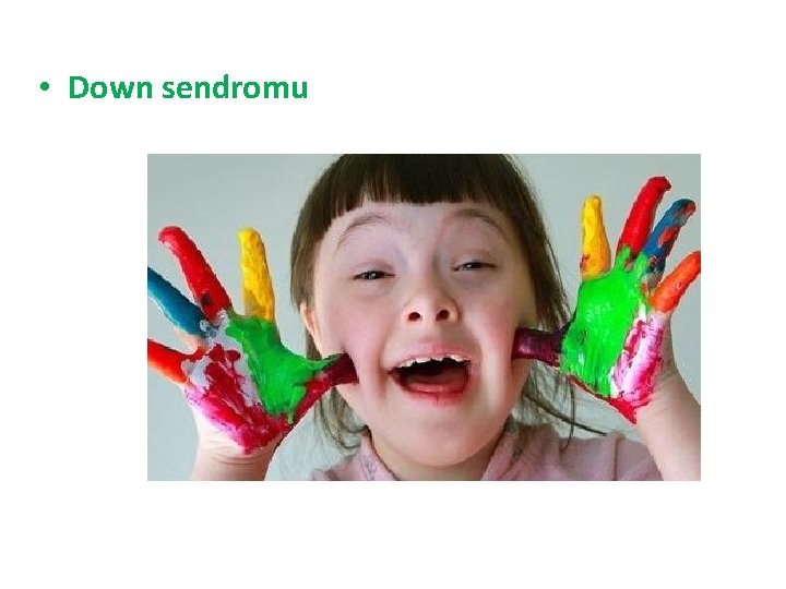  • Down sendromu 