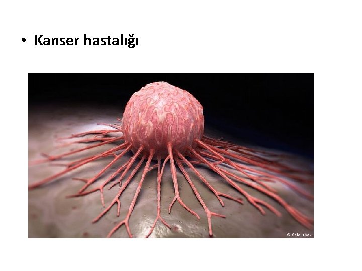  • Kanser hastalığı 