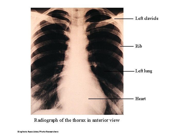Left clavicle Rib Left lung Heart Radiograph of the thorax in anterior view Left clavicle Rib Left lung Heart Radiograph of the thorax in anterior view