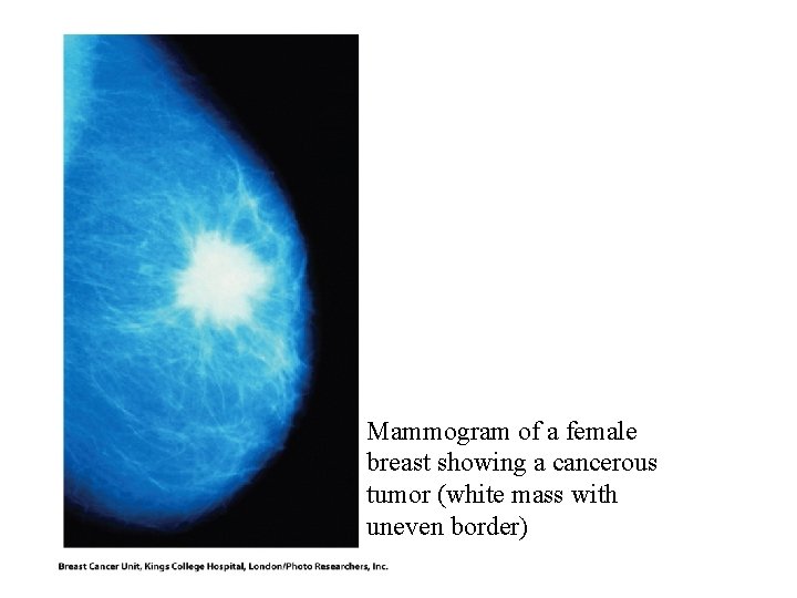 Mammogram of a female breast showing a cancerous tumor (white mass with uneven border) Mammogram of a female breast showing a cancerous tumor (white mass with uneven border)