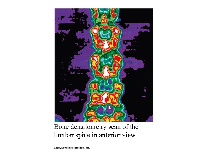 Bone densitometry scan of the lumbar spine in anterior view Bone densitometry scan of the lumbar spine in anterior view