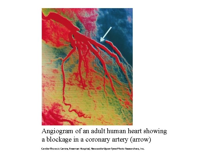 Angiogram of an adult human heart showing a blockage in a coronary artery (arrow) Angiogram of an adult human heart showing a blockage in a coronary artery (arrow)