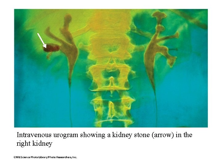 Intravenous urogram showing a kidney stone (arrow) in the right kidney Intravenous urogram showing a kidney stone (arrow) in the right kidney