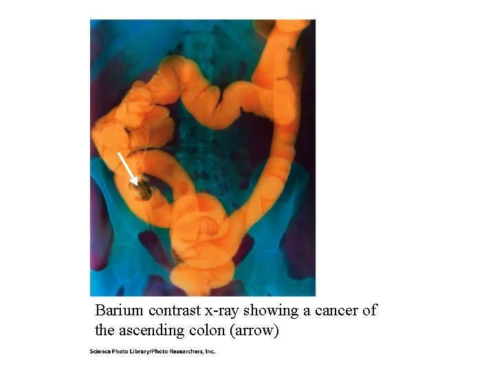 Barium contrast x-ray showing a cancer of the ascending colon (arrow) Barium contrast x-ray showing a cancer of the ascending colon (arrow)