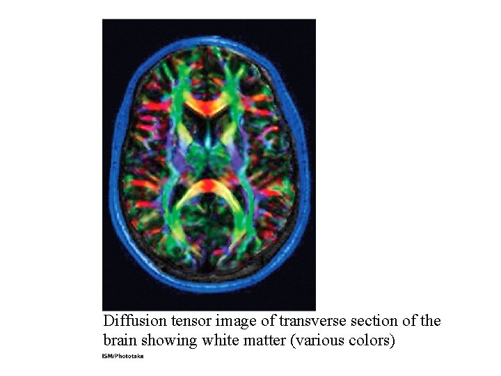 Diffusion tensor image of transverse section of the brain showing white matter (various colors) Diffusion tensor image of transverse section of the brain showing white matter (various colors)