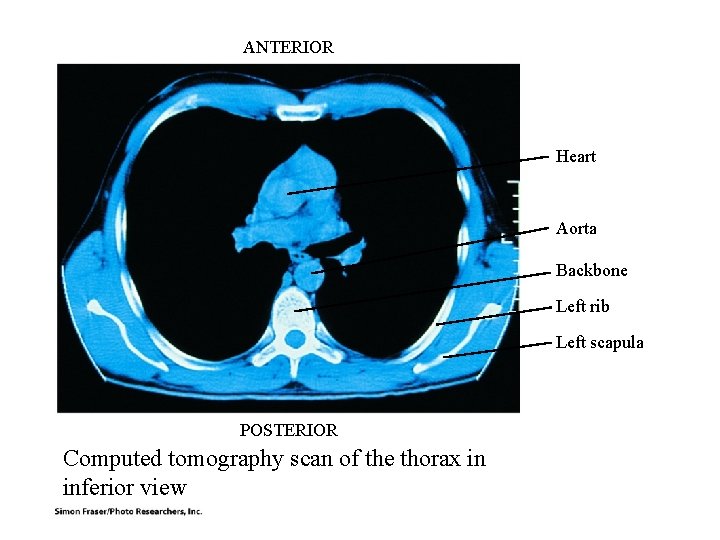 ANTERIOR Heart Aorta Backbone Left rib Left scapula POSTERIOR Computed tomography scan of the ANTERIOR Heart Aorta Backbone Left rib Left scapula POSTERIOR Computed tomography scan of the