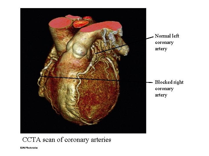 Normal left coronary artery Blocked right coronary artery CCTA scan of coronary arteries Normal left coronary artery Blocked right coronary artery CCTA scan of coronary arteries