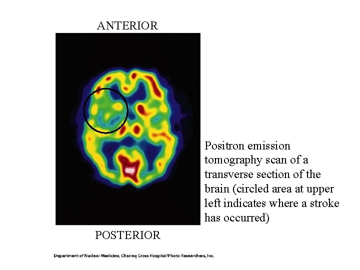 ANTERIOR Positron emission tomography scan of a transverse section of the brain (circled area ANTERIOR Positron emission tomography scan of a transverse section of the brain (circled area