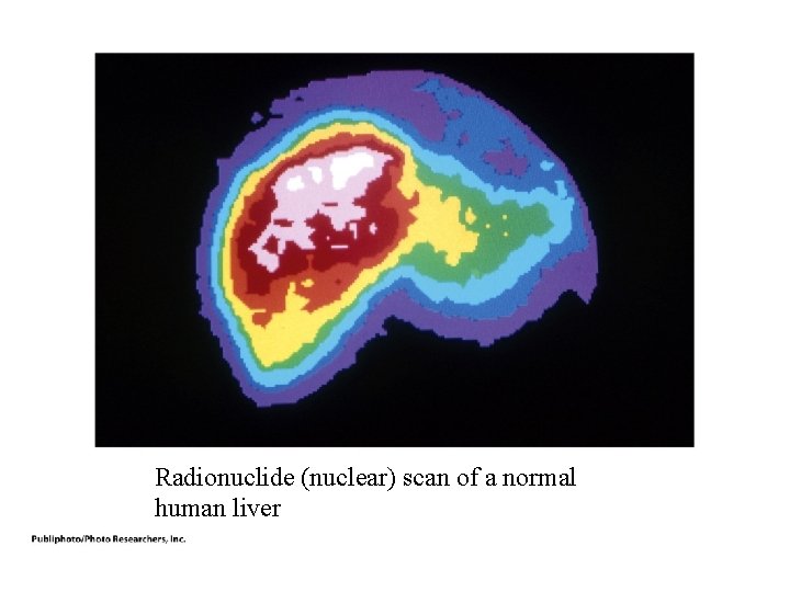 Radionuclide (nuclear) scan of a normal human liver Radionuclide (nuclear) scan of a normal human liver
