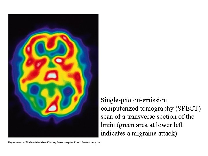 Single-photon-emission computerized tomography (SPECT) scan of a transverse section of the brain (green area Single-photon-emission computerized tomography (SPECT) scan of a transverse section of the brain (green area