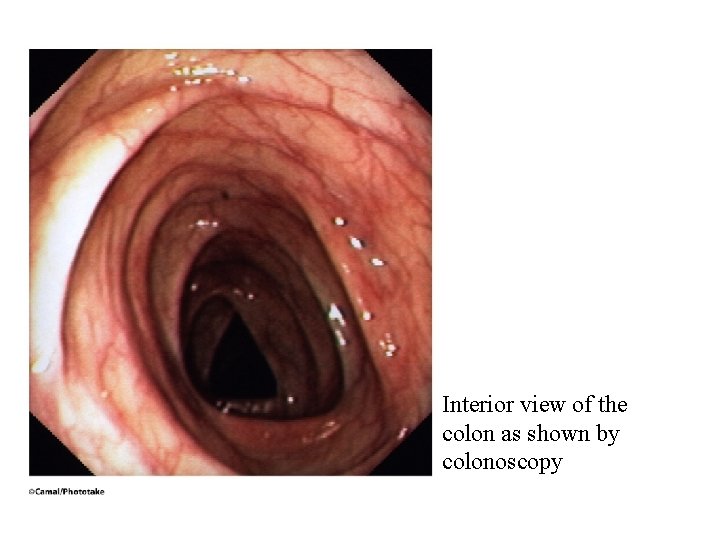 Interior view of the colon as shown by colonoscopy Interior view of the colon as shown by colonoscopy