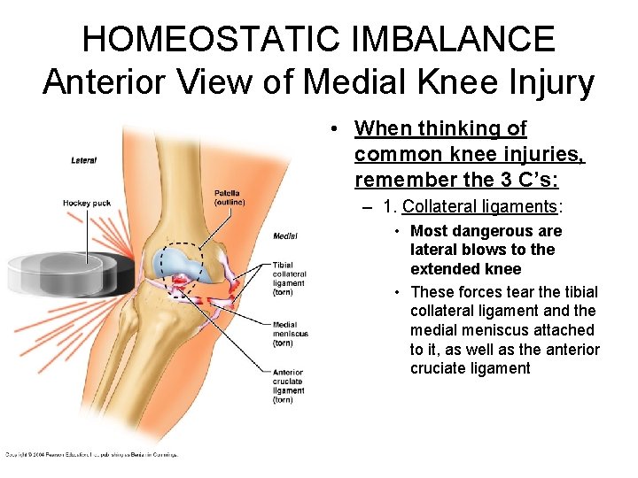 HOMEOSTATIC IMBALANCE Anterior View of Medial Knee Injury • When thinking of common knee