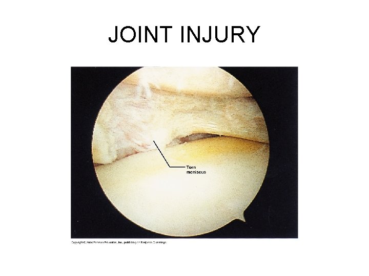 JOINT INJURY 