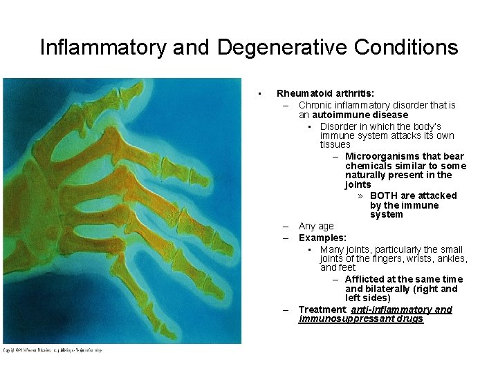 Inflammatory and Degenerative Conditions • Rheumatoid arthritis: – Chronic inflammatory disorder that is an