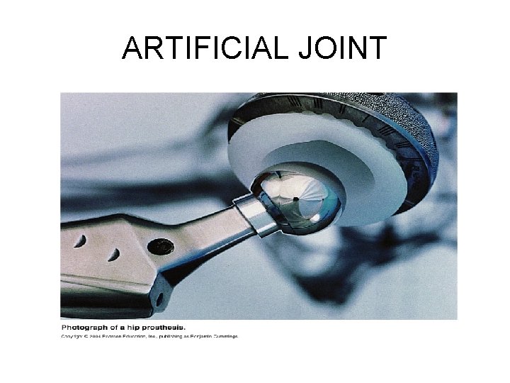 ARTIFICIAL JOINT 