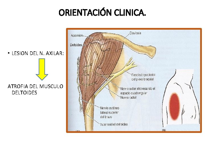 ORIENTACIÓN CLINICA. • LESION DEL N. AXILAR: ATROFIA DEL MUSCULO DELTOIDES 