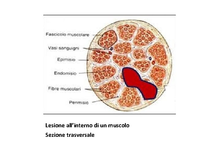 Lesione all’interno di un muscolo Sezione trasversale 