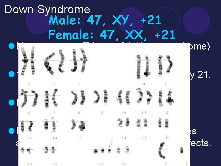 Down Syndrome Male: 47, XY, +21 Female: 47, XX, +21 l Most common, Trisomy