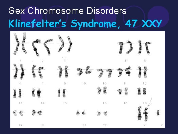 Sex Chromosome Disorders Klinefelter’s Syndrome, 47 XXY l Turner’s Syndrome (nondisjunction) ¡Female inherits only