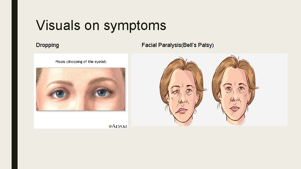 Visuals on symptoms Dropping Facial Paralysis(Bell’s Palsy) 