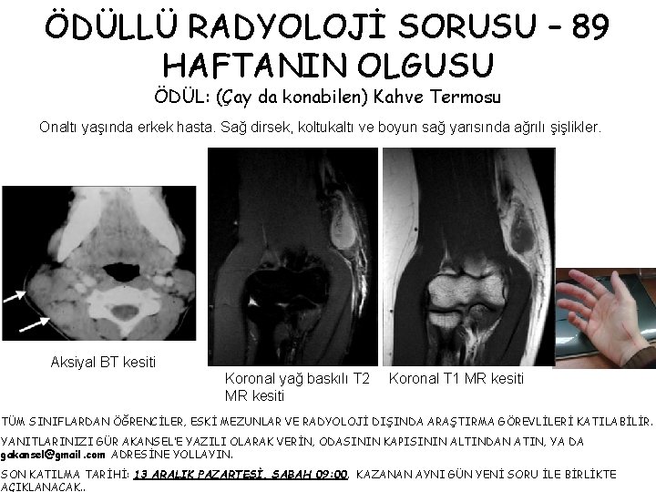 ÖDÜLLÜ RADYOLOJİ SORUSU – 89 HAFTANIN OLGUSU ÖDÜL: (Çay da konabilen) Kahve Termosu Onaltı