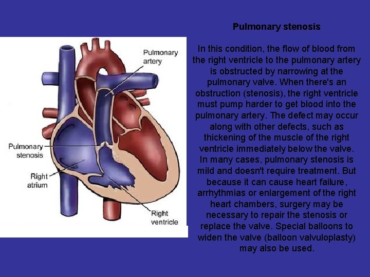 Pulmonary stenosis In this condition, the flow of blood from the right ventricle to
