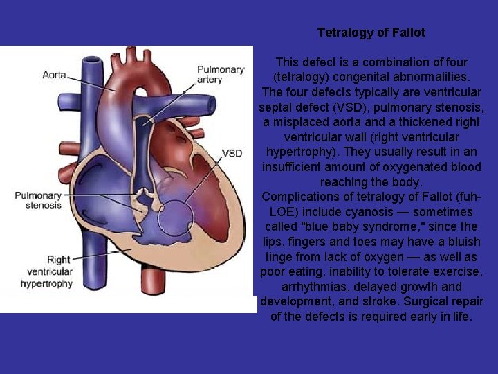 Tetralogy of Fallot This defect is a combination of four (tetralogy) congenital abnormalities. The