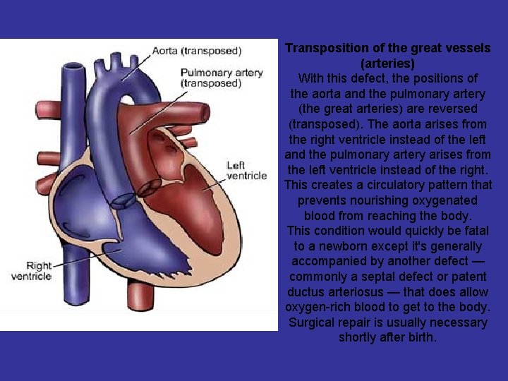 Transposition of the great vessels (arteries) With this defect, the positions of the aorta