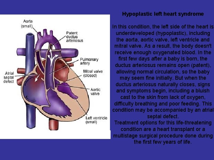 Hypoplastic left heart syndrome In this condition, the left side of the heart is