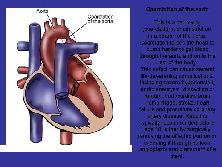 Coarctation of the aorta This is a narrowing (coarctation), or constriction, in a portion