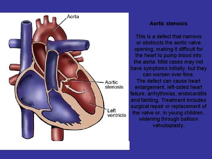 Aortic stenosis This is a defect that narrows or obstructs the aortic valve opening,