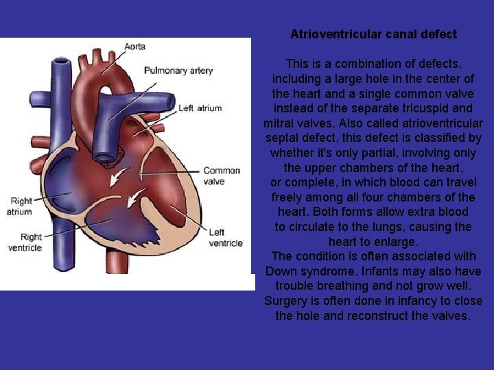 Atrioventricular canal defect This is a combination of defects, including a large hole in