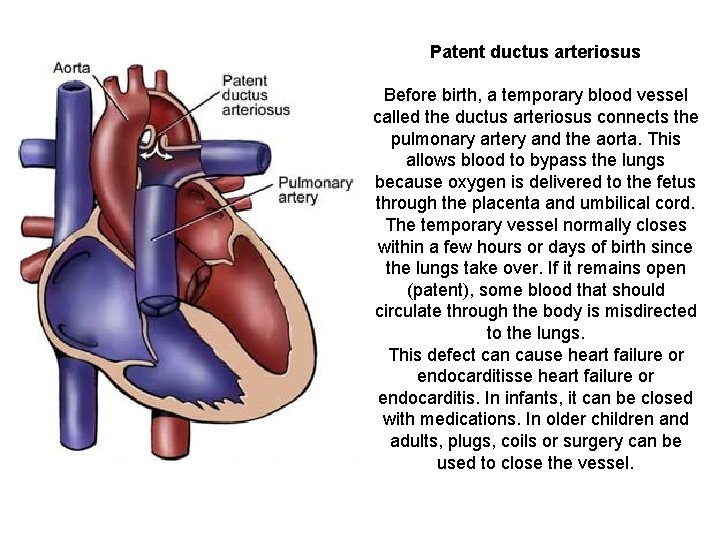 Patent ductus arteriosus Before birth, a temporary blood vessel called the ductus arteriosus connects