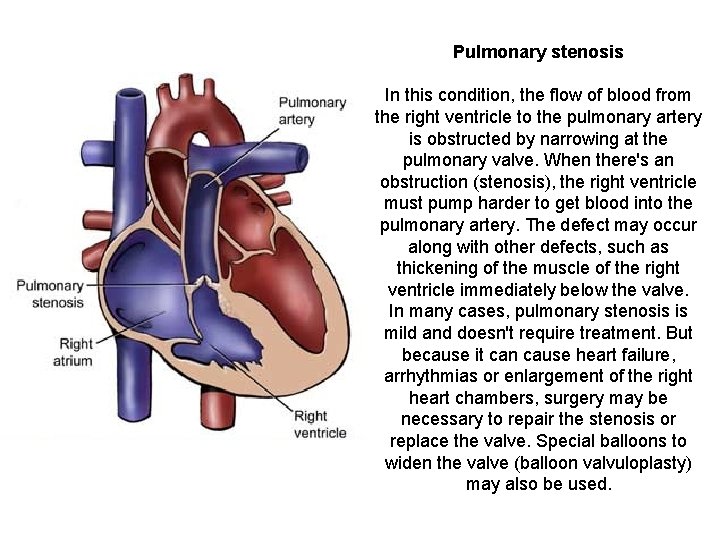 Pulmonary stenosis In this condition, the flow of blood from the right ventricle to