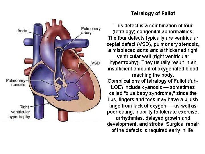Tetralogy of Fallot This defect is a combination of four (tetralogy) congenital abnormalities. The