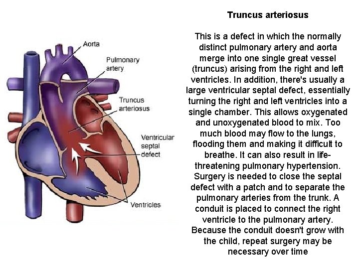 Truncus arteriosus This is a defect in which the normally distinct pulmonary artery and