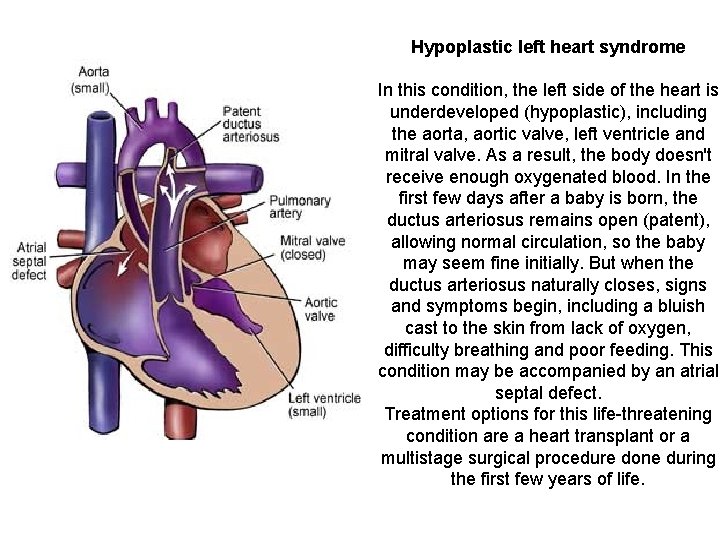 Hypoplastic left heart syndrome In this condition, the left side of the heart is